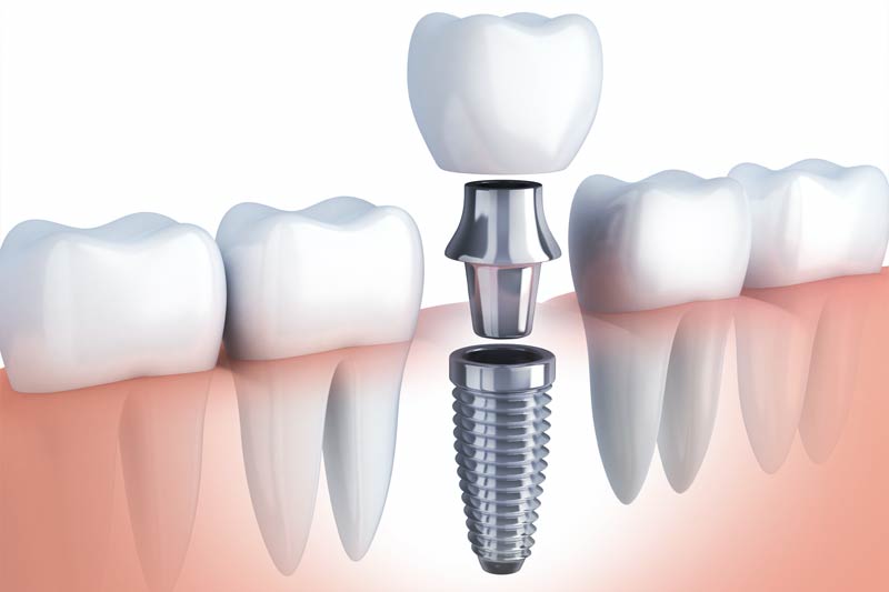 Implants Dentist in Altamonte Springs