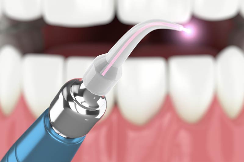 Fotona Laser Painless Fillings in Altamonte Springs