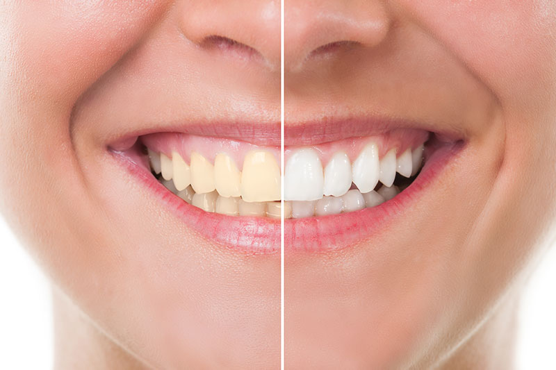 Teeth Whitening in Altamonte Springs