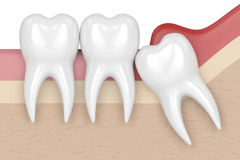 Wisdom Tooth Removal in Altamonte Springs
